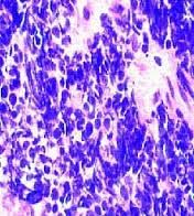 small cell lung cancer 