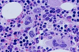 thrombocytopenia