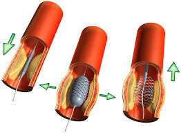 coronary artery disease